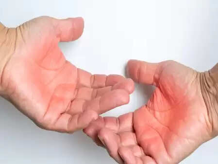 डेंगू से बचाव बेहद जरूरी, देसी नुस्खों से पाया जा सकता है आराम