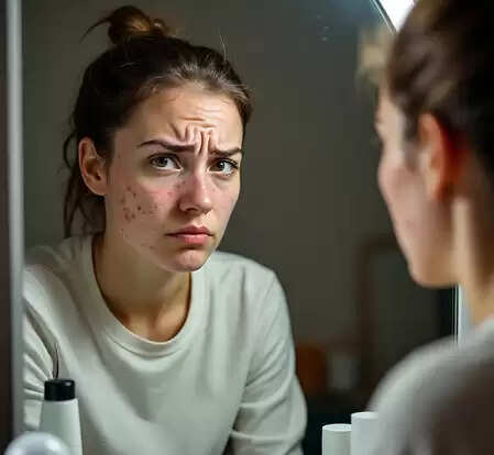 चेहरे के दाने और मुंहासे से हैं परेशान? आयुर्वेद और विज्ञान से जानें असली कारण