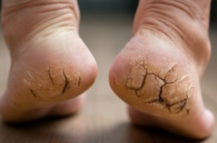 इस आयुर्वेदिक उपाय से फटी एड़ियों से मिलेगा छुटकारा, फिर से बन सकती हैं मुलायम