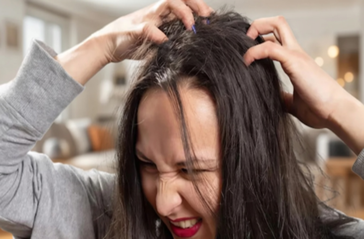 सिर से जूं को तुरंत खत्म करेंगे ये दो उपाय, खुजली और डैंड्रफ से भी मिलेगी राहत