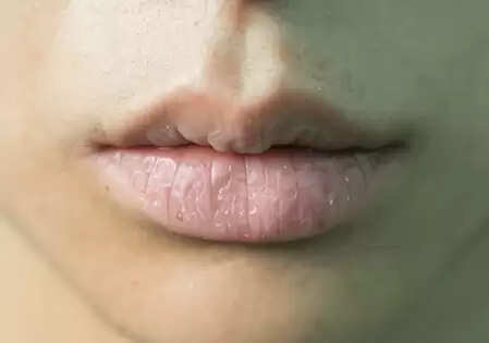 सर्दियों में भी रखें होंठों की नमी बरकरार, अपनाएं घरेलू और सुरक्षित उपाय