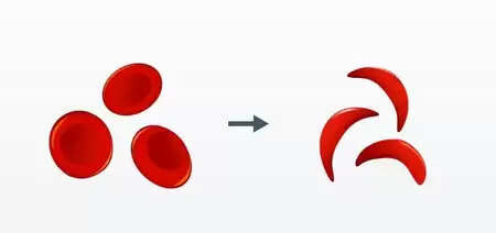 भारत को सिकल सेल रोग से मुक्ति दिलाएगा 'बिरसा-101', जानें क्यों है खास