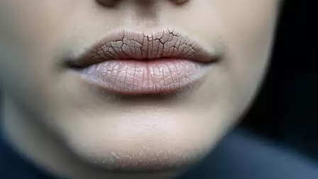 मुंह सूखना सिर्फ डिहाइड्रेशन नहीं, गंभीर रोगों का संकेत भी, आयुर्वेद से जानें समाधान