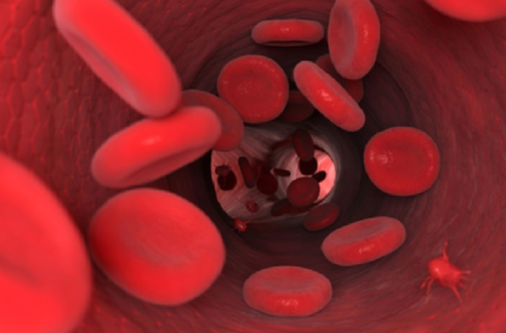 आयुर्वेद के 3 उपाय दूर करेंगे एनीमिया की परेशानी, रखना होगा कुछ विशेष बातों का ध्यान