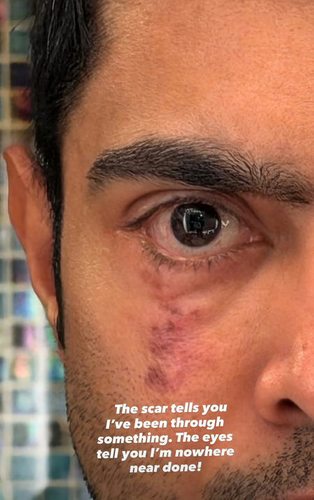 अभिषेक बनर्जी की 'स्कार' पोस्ट से सियासी हलचल, अमेरिका में इलाज के बीच इंस्टाग्राम स्टोरी बनी चर्चा का विषय