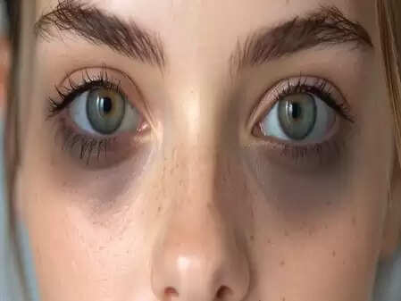 डार्क सर्कल्स : आंखों के आसपास के ये काले घेरे शारीरिक थकान का भी देते हैं संकेत