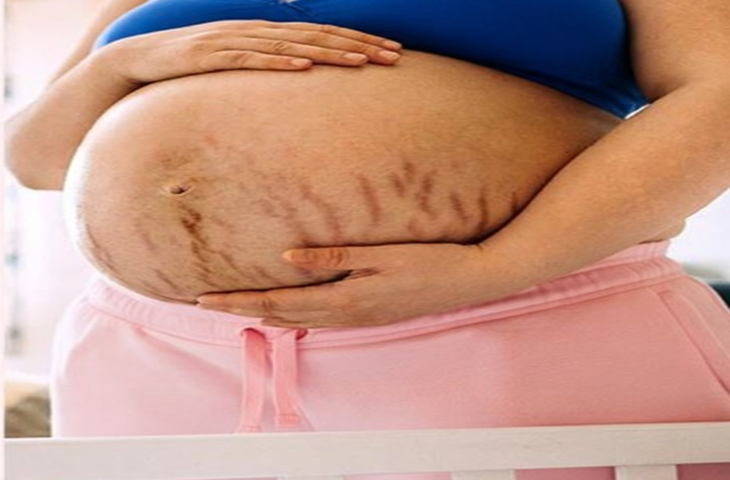 गर्भावस्था में स्ट्रेच मार्क्स? आयुर्वेद से जानिए बचाव के उपाय