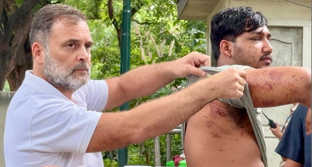 राहुल गांधी ने घायल छात्र को पेशकर लगाया आरोप, छात्रों पर पेलेट गन चलाकर सच छिपा रही सरकार