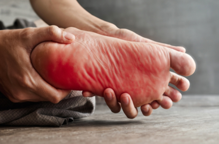 बर्निंग फीट सिंड्रोम : पैरों की जलन के पीछे बड़े कारण, गंभीर बीमारियों का भी 'खतरा'