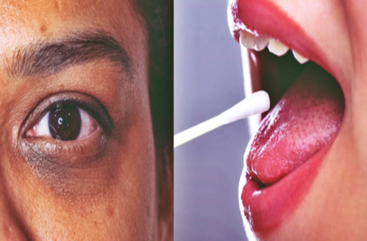 डार्क सर्कल हो या पिंपल्स, बड़े काम की है मुंह की लार