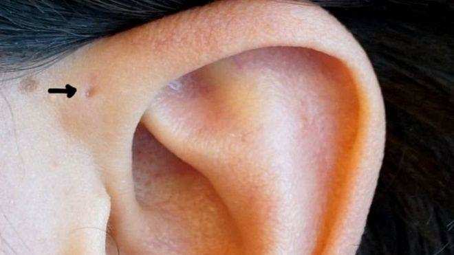 क्या आपके कान में कोई छेद हैं, जो आपने कभी नहीं देखा