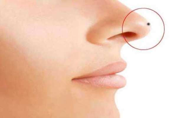 क्या आपके नाक के आस-पास भी है तिल, तो अभी तुरंत पढ़ें यह खबर