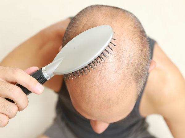 इन बीमारियों के कारण झड़ते सिर के बालों को इन उपायों की मदद से रोके