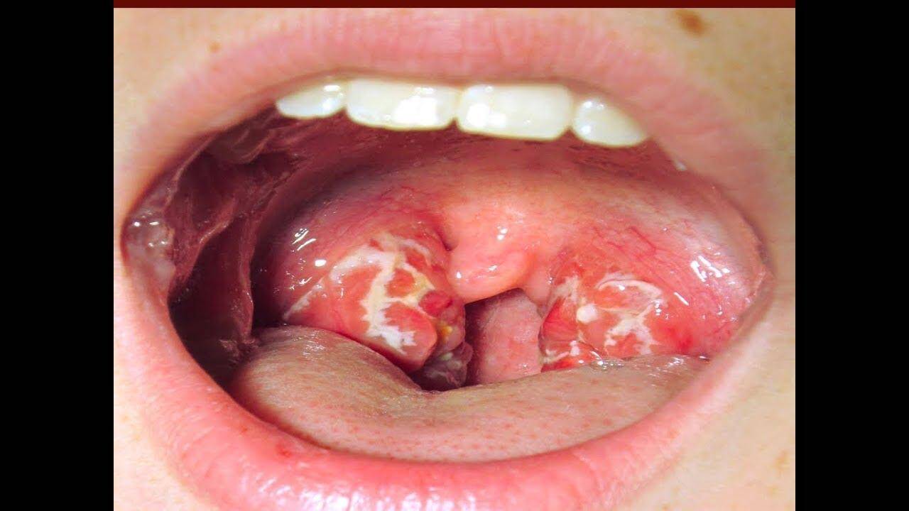 गले में छालों करें तुरंत ये घरेलू उपाय कहीं बन जाए बड़ी परेशानी की वजह