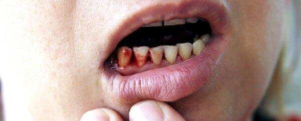 स्कर्वी रोग होता है बहुत ही घातक बच सकते हैं इन सामान्य आहारों से