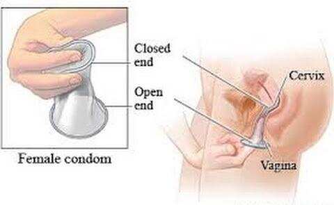 फीमेल कंडोम का कैसे करें इस्तेमाल, क्या है इसके फायदे और नुकसान
