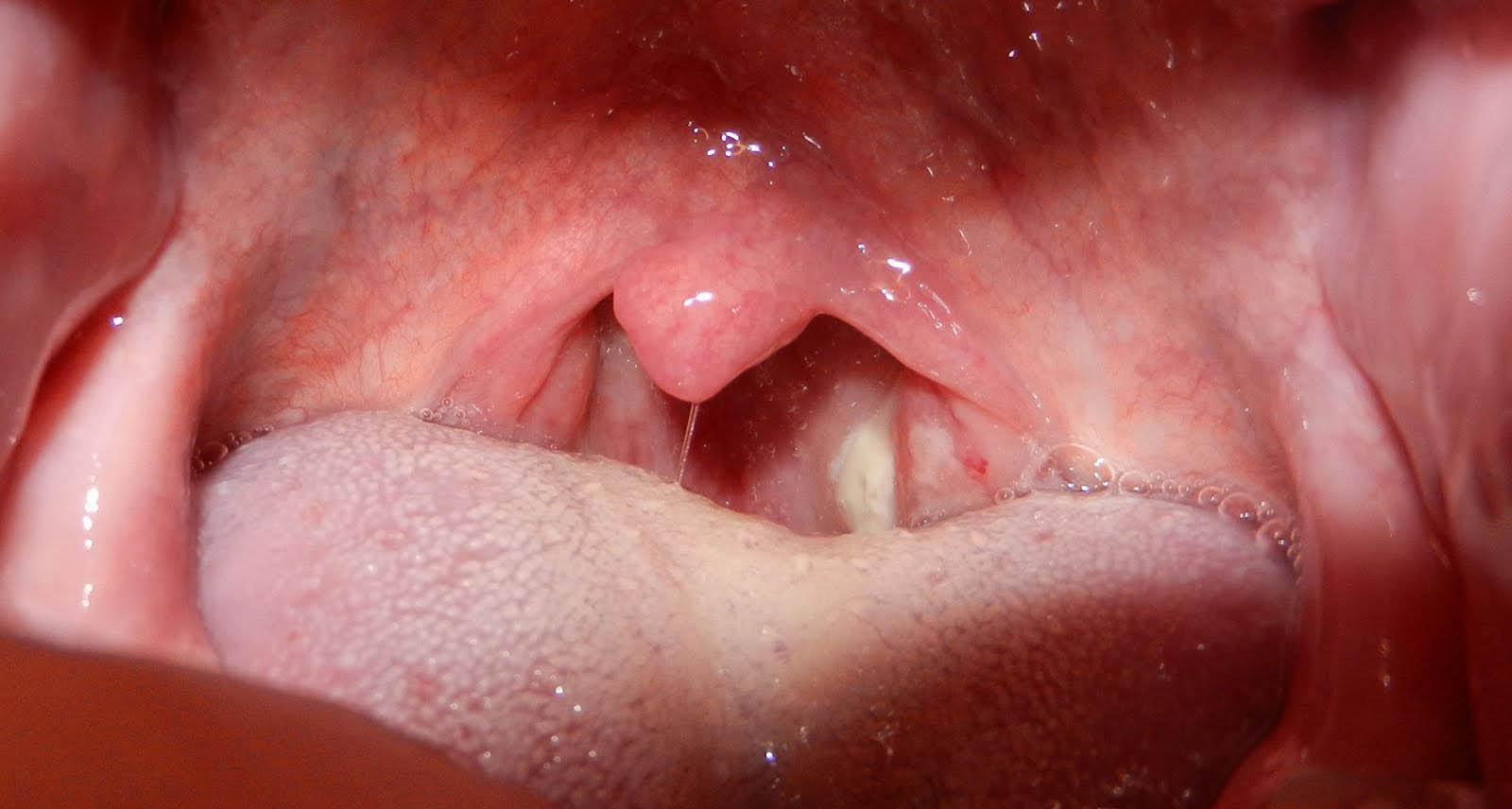 गले में छालों करें तुरंत ये घरेलू उपाय कहीं बन जाए बड़ी परेशानी की वजह