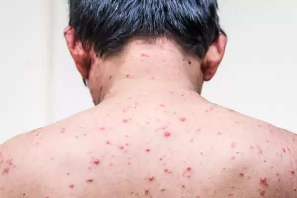 Chicken pox: चिकन पॉक्स हो तो क्या करें? आइऐ जानते है