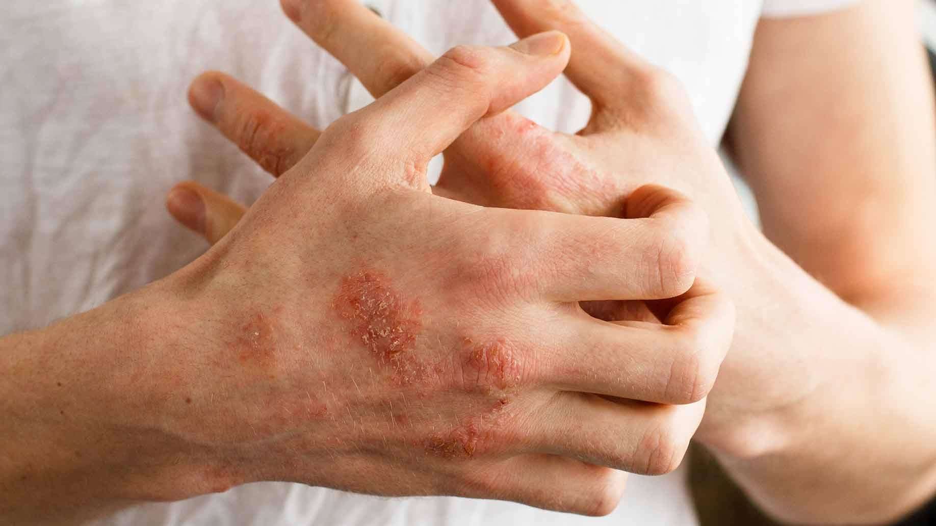 हमारी त्वचा संवेदन शील है या नही यह बताते हैं ये लक्षण 