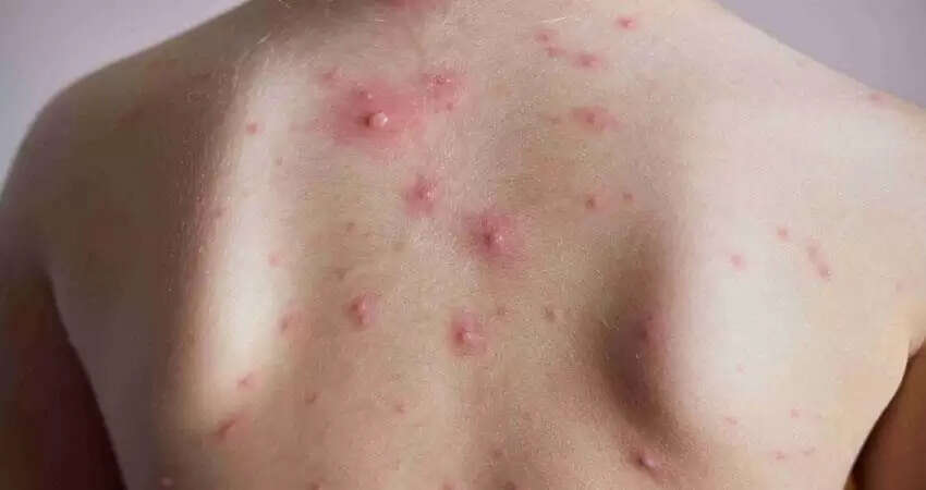 Chicken pox: चिकन पॉक्स हो तो क्या करें? आइऐ जानते है