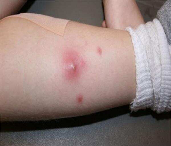 चेहरे या शरीर पर होने वाले फोड़े और फुंसियों से बचने के ये हैं कुछ घरेलु उपाय