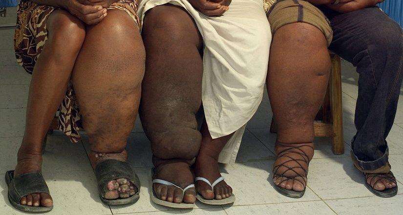 जानें क्या है फाइलेरिया की बीमारी और यह कैसे होती है