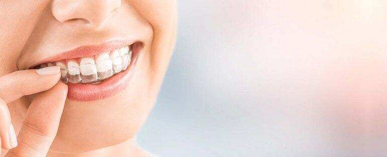 दांतों में तार लगवाने के जाने फायदे और नुकसान