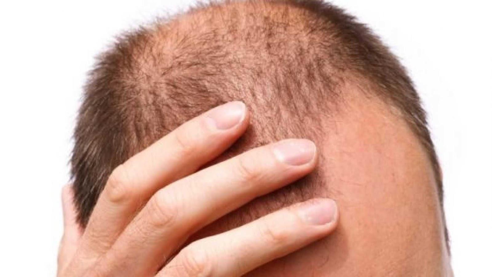 टेंशन लेने का आपके बालों पर क्‍या प्रभाव पड़ता है, जानें इससे होने वाले दुष्‍परिणाम