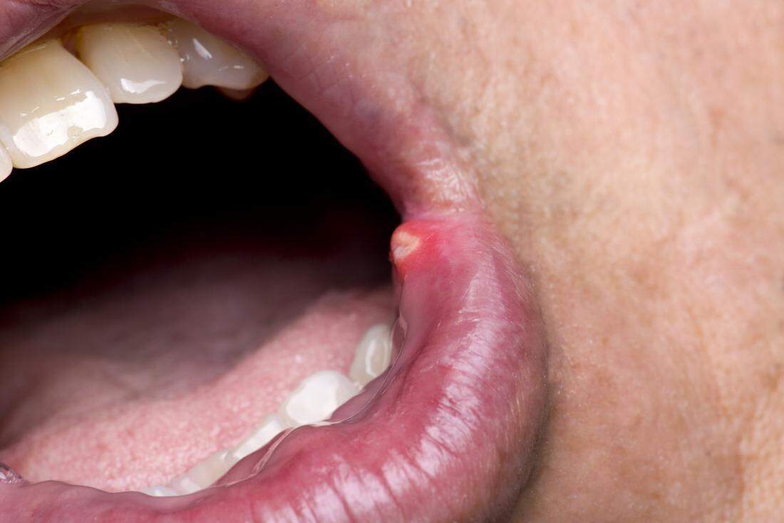 मुंह के छालों का कारण शरीर में गर्मी का बढना है, करें इसका घरेलू उपचार