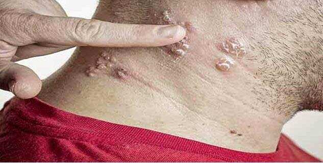 10 मिनटों में दाद एवं खुजली को खत्म कर देगा यह कम कीमत वाला घरेलु नुस्खा, आप भी आजमाएं