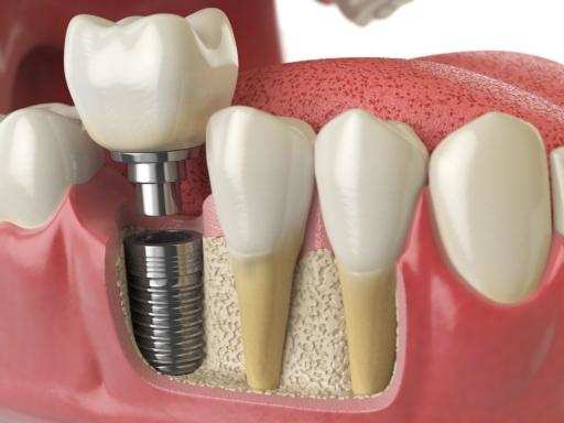 Dental implants: क्या आप दंत प्रत्यारोपण के बाद यह चीजे खाते हैं? जानिए क्या कहते हैं विशेषज्ञ