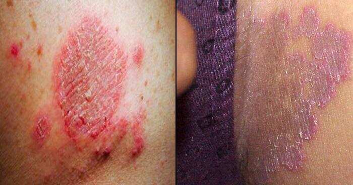 10 मिनटों में दाद एवं खुजली को खत्म कर देगा यह कम कीमत वाला घरेलु नुस्खा, आप भी आजमाएं