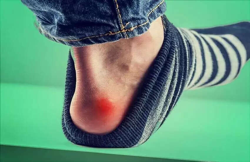 Home Remedies: पैरों के फफोले से छुटकारा पाने के उपाय