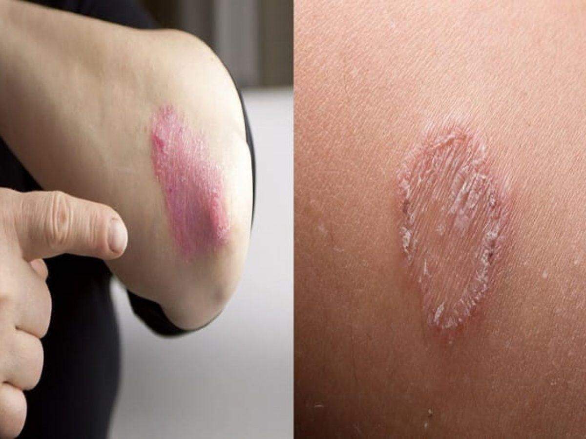 Home remedies: इन घरेलू उपायों को आजमाकर दाद, खाज और खुजली की समस्या को दूर करें