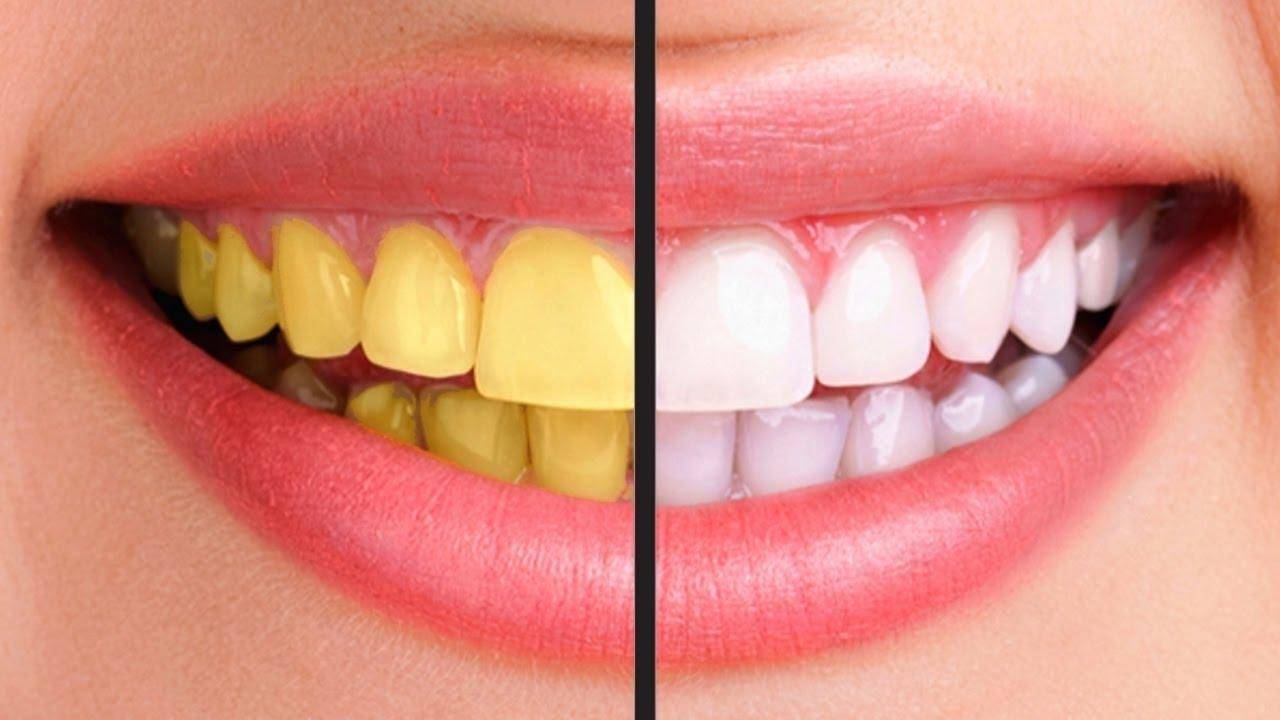 इन आसान घरेलू नुस्खों से पाएं चमकदार और मजबूत दांत