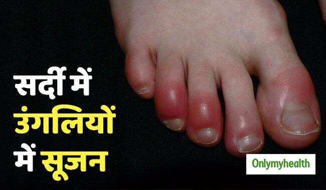 ठंड में पैरों की उंगलियों पर होने वाली सूजन का इलाज