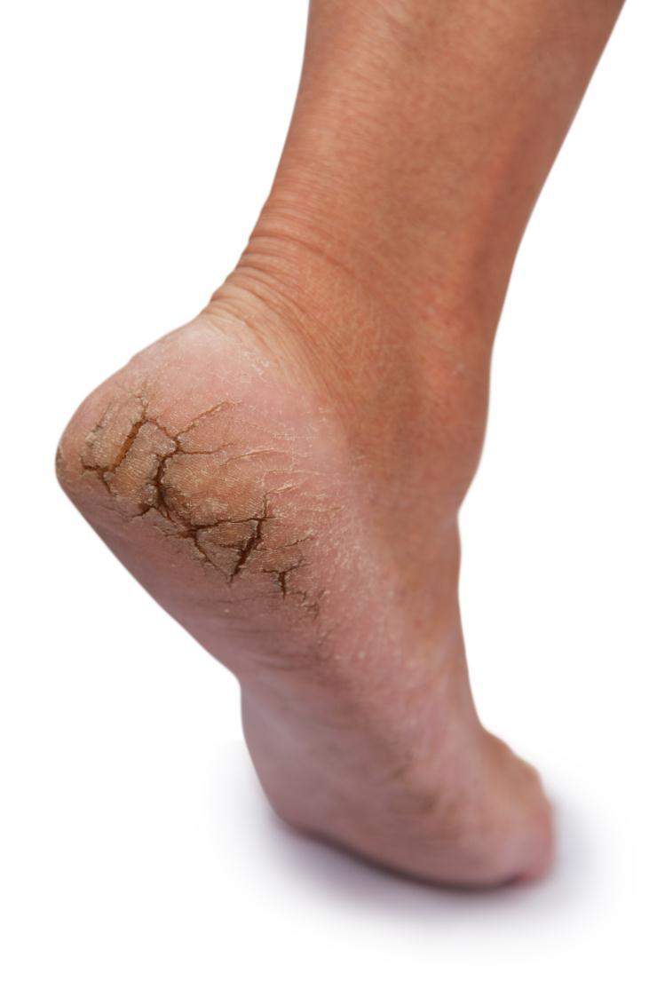 घरेलु उपायों का इस्तेमाल कर रखें पैरों की त्वचा को स्वस्थ