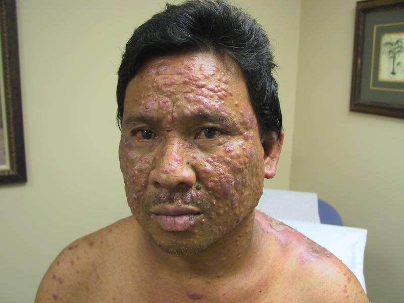 खुलासा, जानकारी के अभाव में बनता है कुष्ठ रोग इस गंभीर रोग का कारण