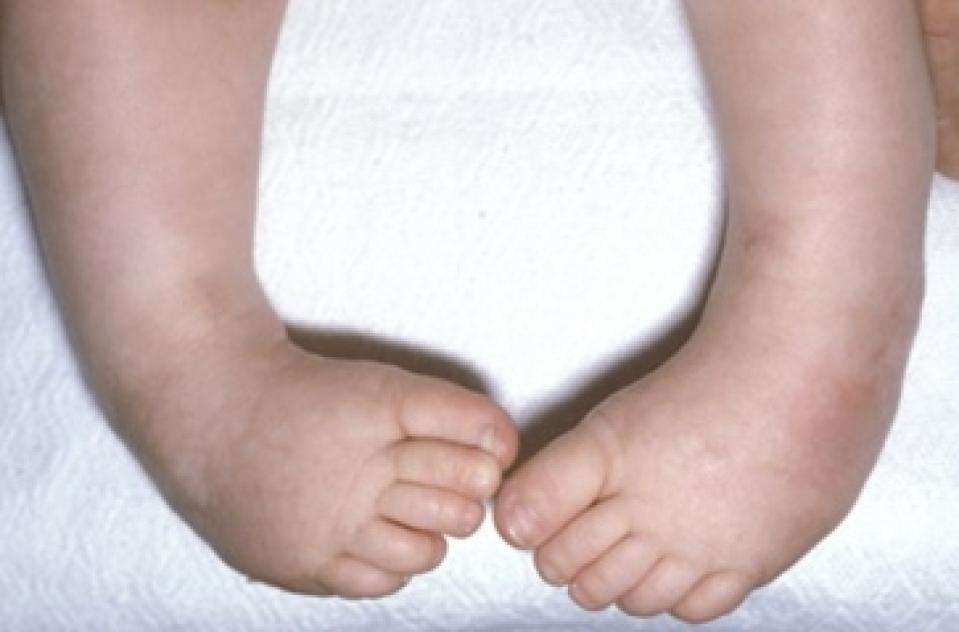 जन्मजात ऑर्थोपेडिक विसंगति ‘क्लबफुट’ का उपचार संभव