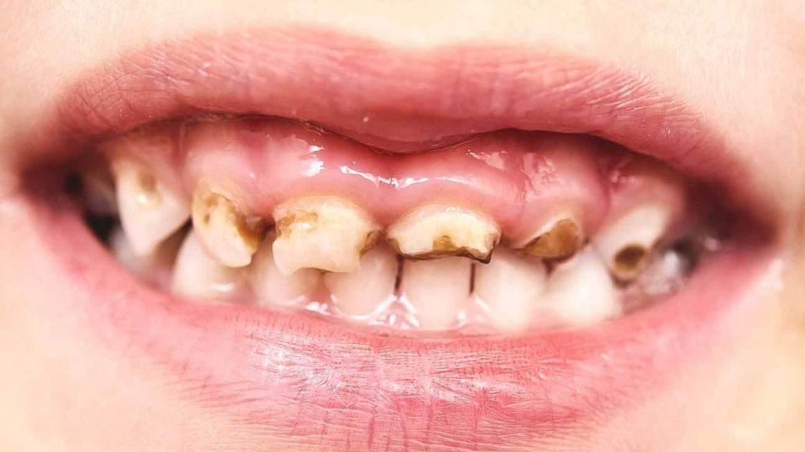 दाँत सड़ने की नहीं है वजह सिर्फ खाना बल्कि इन कारणों से भी सड़ सकते हैं 