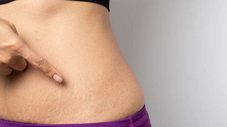 Skin care tips:गर्भावस्था के बाद होने वाली स्ट्रेच मार्क्स के निशान को इन उपायों से करे दूर