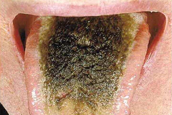 वैज्ञानिकों ने काली जीभ को बताया बीमारी, अपशकुन से नकारा 