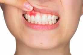 दांतों का फोड़ा है दर्दनाक, जानिए कैसे करें उपचार