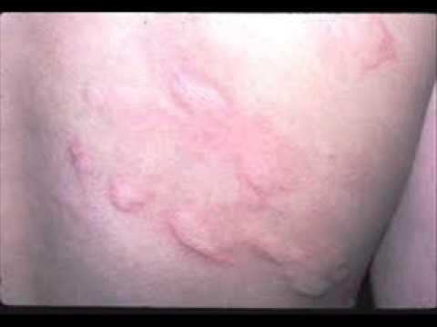 इस कारण होते हैं शरीर पर लाल चिकत्ते, बचने के लिए करें उपाय