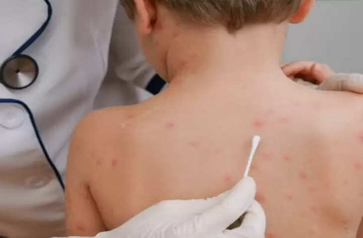 Chicken pox: चिकन पॉक्स हो तो क्या करें? आइऐ जानते है