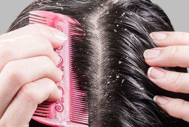 Hair Tips: रूसी से छुटकारा पाना मुश्किल नहीं है, घरेलू उपचार इस समस्या का समाधान है