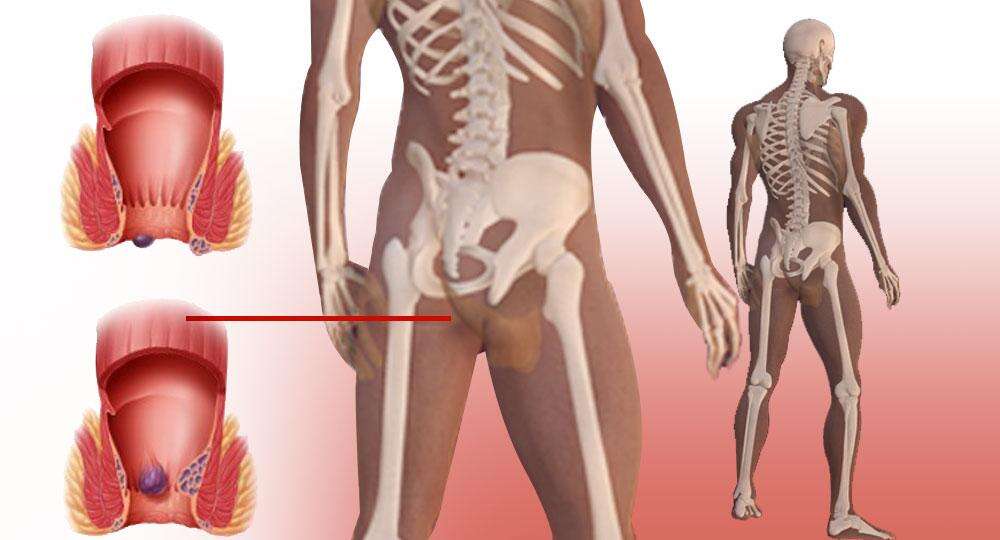 आइए जानें कितने प्रकार के होते है बवासीर