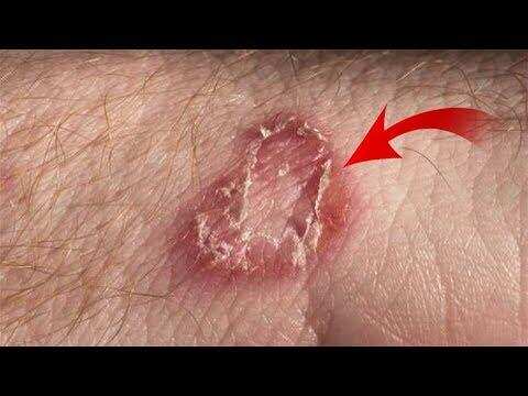 10 मिनटों में दाद एवं खुजली को खत्म कर देगा यह कम कीमत वाला घरेलु नुस्खा, आप भी आजमाएं