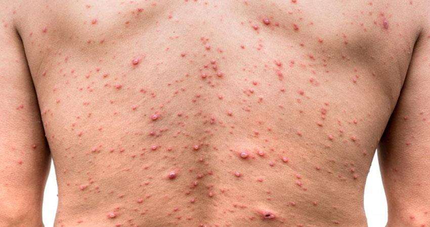 चिकन पॉक्स दूर करने के लिए अपनाएं घरेलू उपचार, लक्षण और कारण जानें