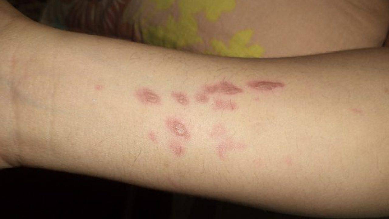 Get Rid of Blisters: इन 5 तरीकों से फफोले से छुटकारा पाएं